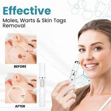 1 pieza portátil avanzado facial eliminación de pecas láser pluma herramienta para el cuidado de la piel