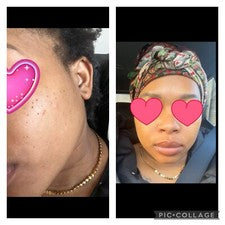 Juego de cuidado de la piel de cúrcuma | Suero y exfoliante de vitamina C | Aceite de vitamina E | Cuidado de manchas os