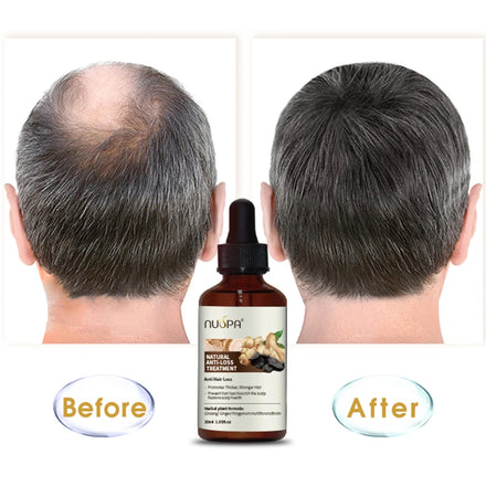 NUSPA Private Label Herbal Vegan Anti Hair Loss Treatment Ginger Hair Growth Oil for Bald Hair
